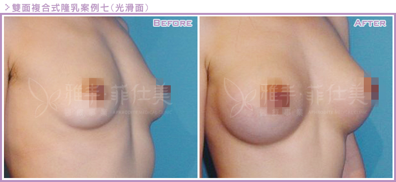 雙面複合式隆乳案例7