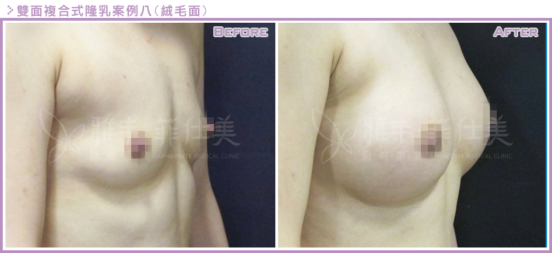 雙面複合式隆乳案例8