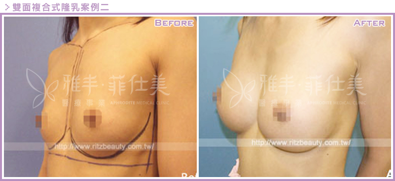 雙面複合式隆乳案例2