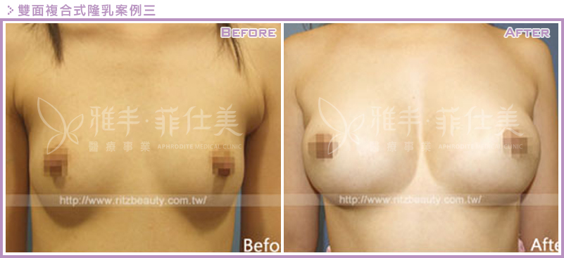 雙面複合式隆乳案例3