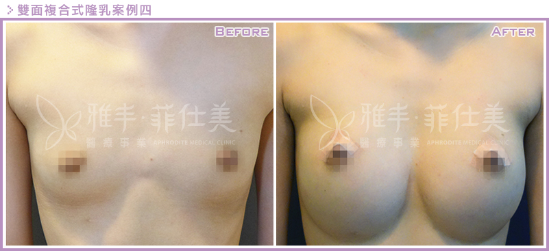 雙面複合式隆乳案例4