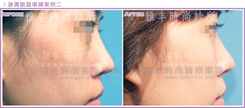 眼窩淚溝填補案例二,雅丰診所