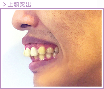 上顎突出示意圖