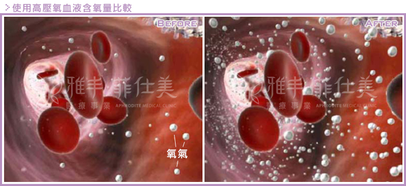 高壓氧療程後血液含氧量比較圖