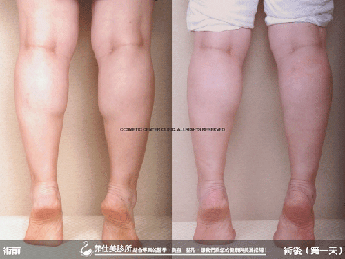 雅丰診所 纖纖美腿雷射