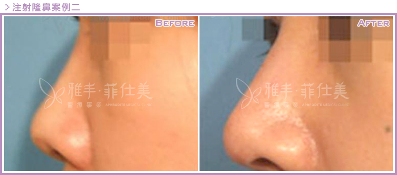 晶亮瓷(微晶瓷)注射隆鼻案例二