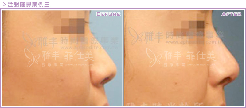 晶亮瓷(微晶瓷)注射隆鼻案例三