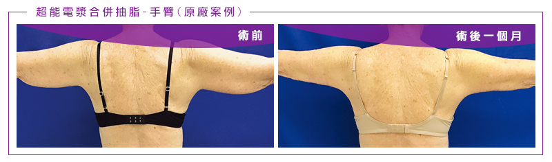 超能電漿案例,手臂鬆弛,手臂抽脂,原廠案例五-2