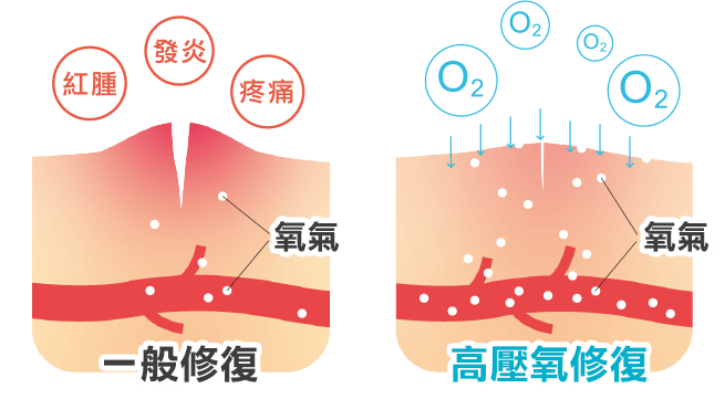 高壓氧艙的治療原理