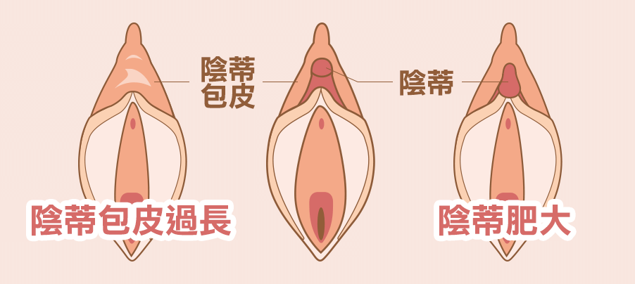 常見陰蒂困擾, 陰蒂包皮過長, 陰蒂肥大