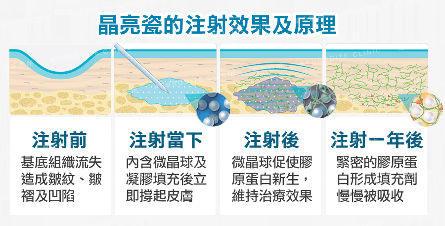 晶亮瓷注射效果及原理