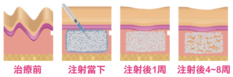 AestheFill, 艾麗斯, 精靈針, 效果