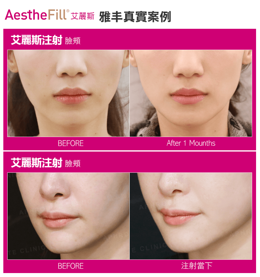 艾麗斯, Aesthefill, 精靈針, 第三代童顏針