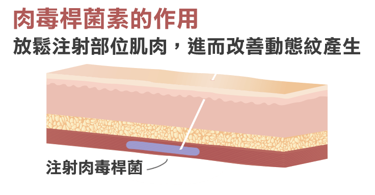 肉毒桿菌, botox, 除皺, 放鬆肌肉