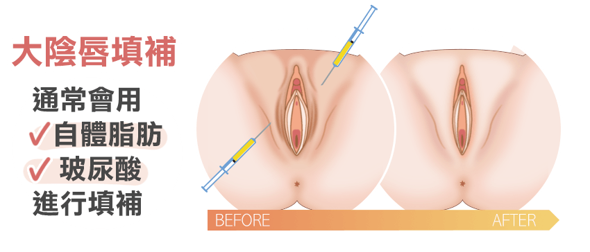 大陰唇填補, 自體脂肪, 玻尿酸