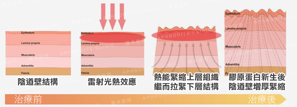 黛娜蜜私皇后雷射治療原理,G緊雷射治療原理,fotona