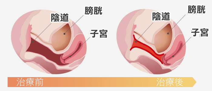 黛娜蜜私皇后雷射治療效果示意圖