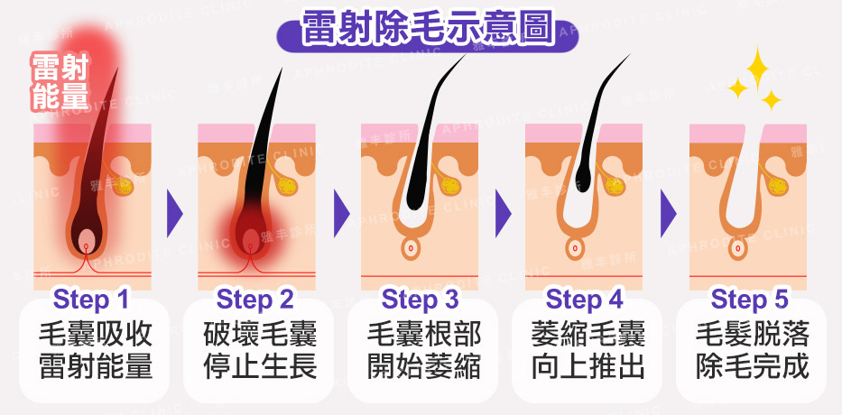 雷射除毛示意圖