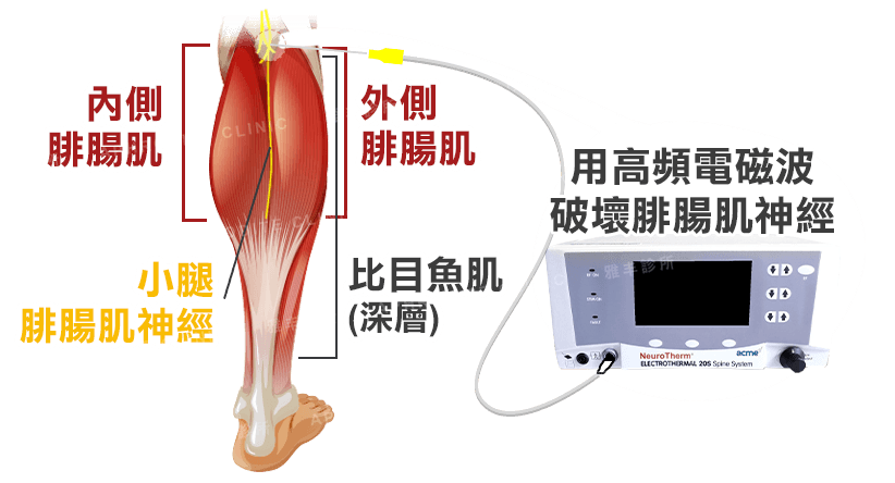 小腿肌肉神經示意圖,先鮮美腿治療示意圖