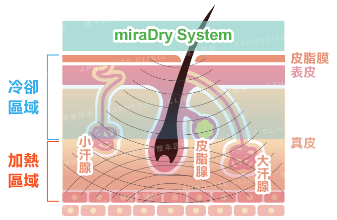miraDry清新微波治療原理