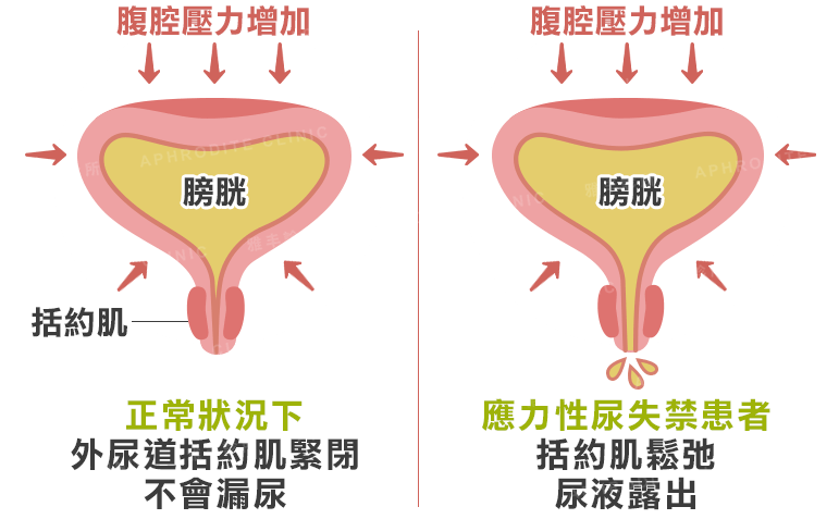 頻尿漏尿好困擾？產後漏尿怎麼辦？了解原因及治療方式