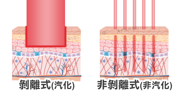 飛梭雷射治療原理,非剝離式,非汽化