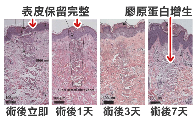 3D變頻飛梭雷射,膠原蛋白增生,肌膚修復