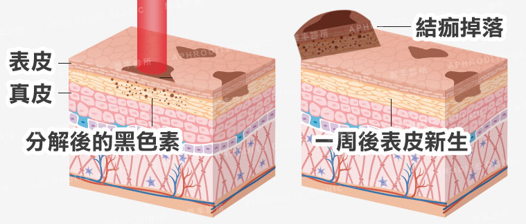 日式光纖美白原理