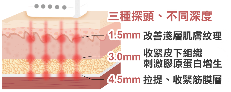 utims, 優提斯, 音波拉提, 音波拉皮, 治療深度