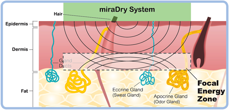 miraDry腋淨爽微波熱能除汗-治療能量示意圖