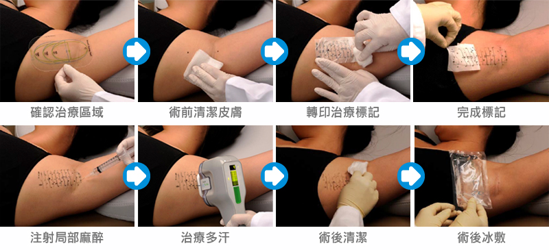 miraDry腋淨爽微波熱能除汗-治療流程