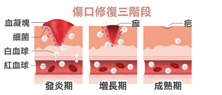 疤痕整形, 傷口癒合階段, 疤痕形成階段