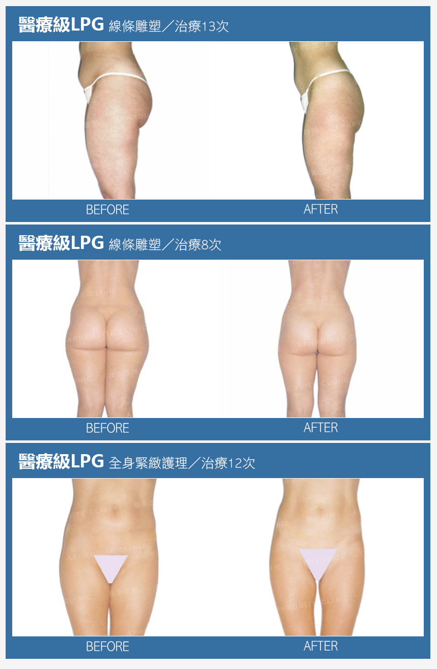 LPG案例