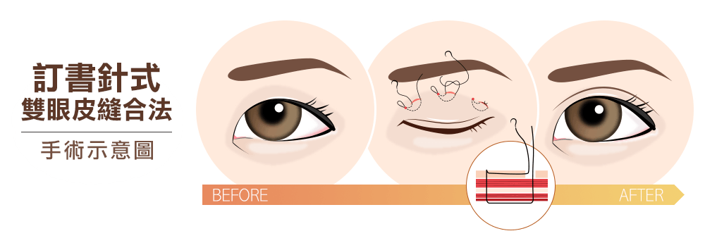 縫雙眼皮-訂書針式雙眼皮手術示意圖