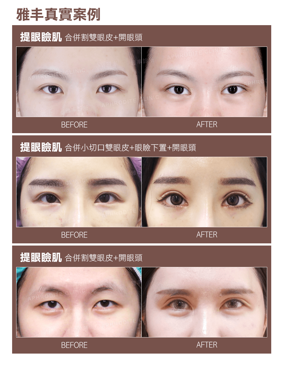 提眼瞼肌真實案例