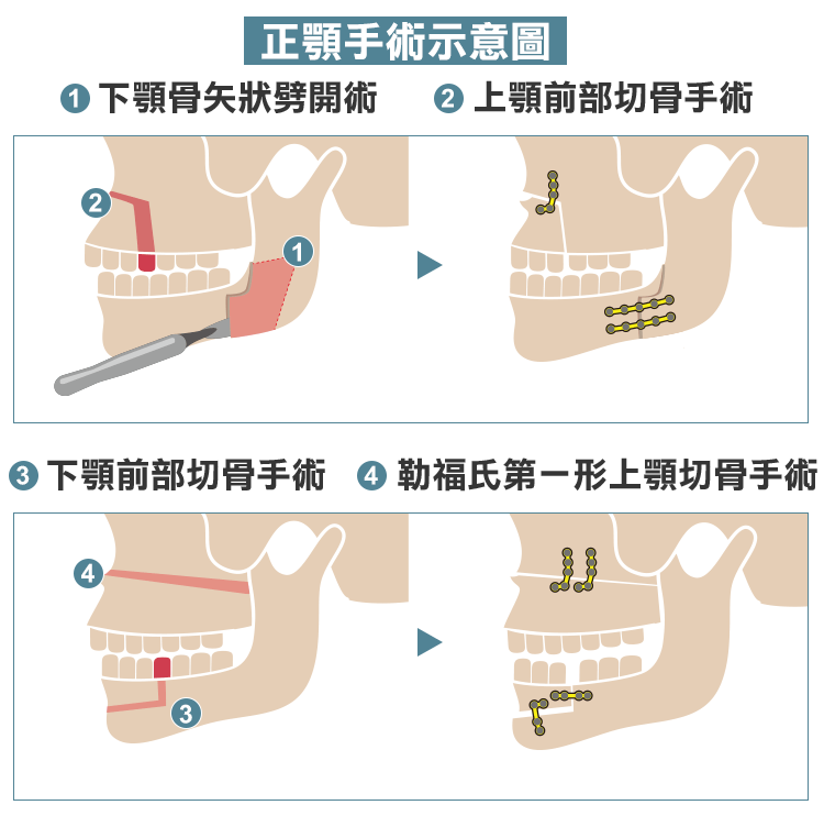 正顎手術, 手術示意圖