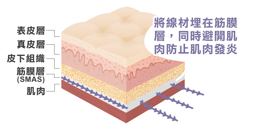 埋線, 線雕, 拉皮, 迷你拉皮, 藍鑽魚骨, 筋膜層, SMAS, 癮痕