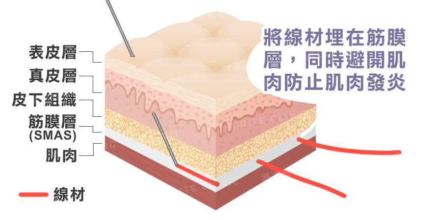 埋線, 線雕, 拉皮, 迷你拉皮, 藍鑽魚骨, 筋膜層, SMAS, 癮痕