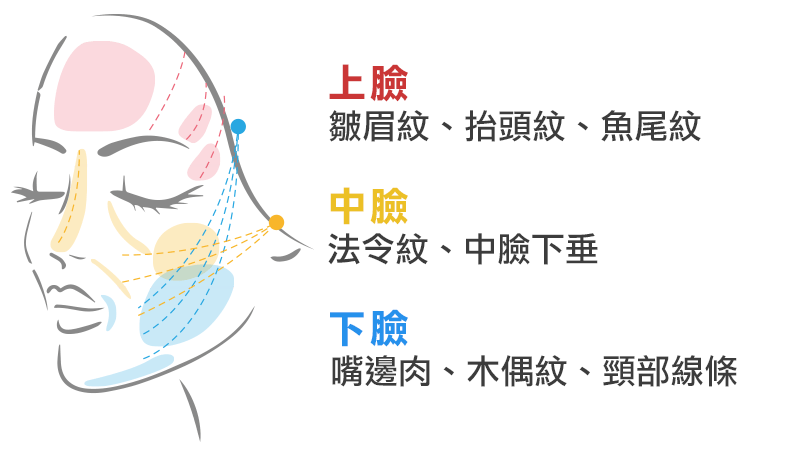 埋線, 線雕, 迷你拉皮, 拉皮, 適用部位, 改善