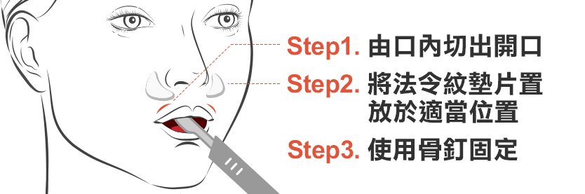 墊法令紋, 手術示意, 步驟