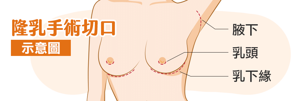 隆乳手術, 切口位置