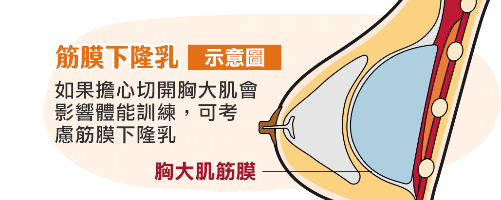 筋膜下隆乳, 手術示意圖