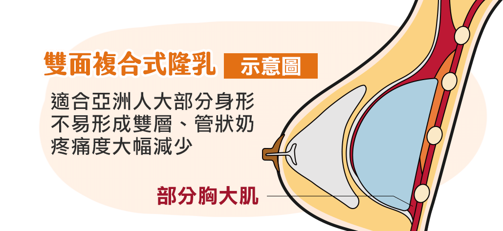 雙面複合式隆乳, 手術示意圖