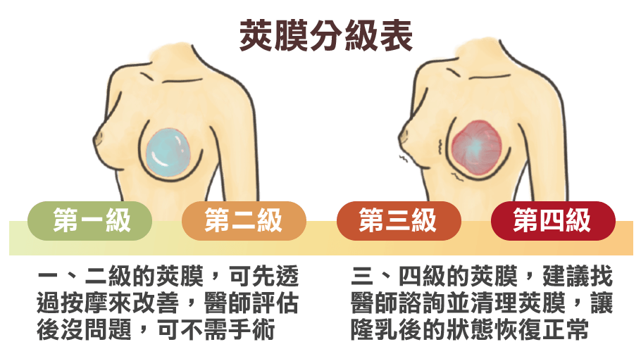 莢膜臨床分級