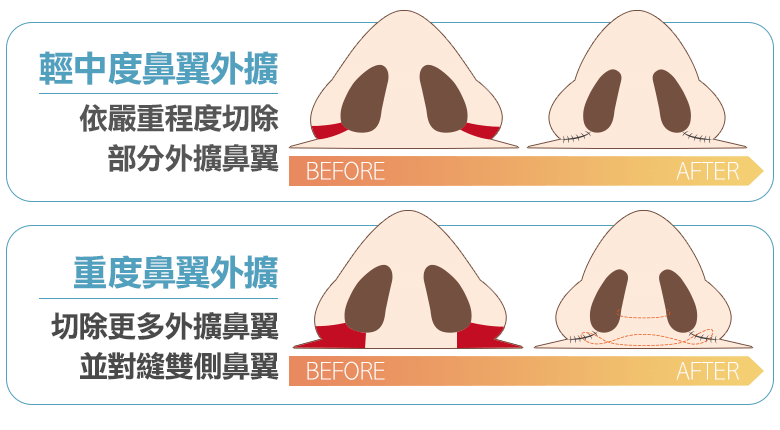 輕度鼻翼外擴, 鼻基底切除