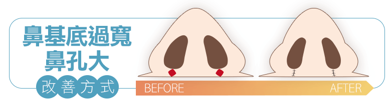 鼻孔過大, 鼻基底切除