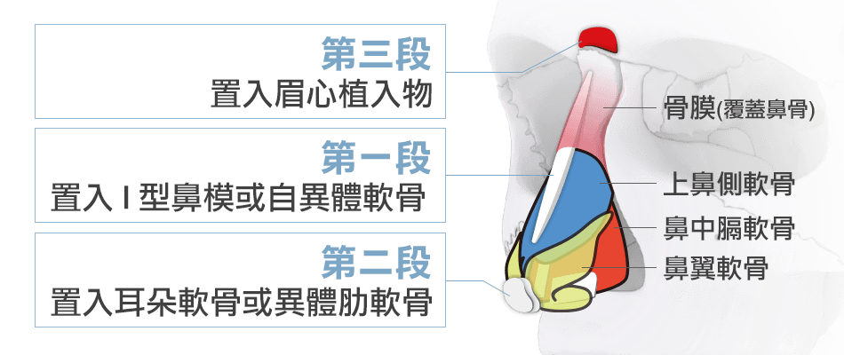 結構式隆鼻, 三段式隆鼻
