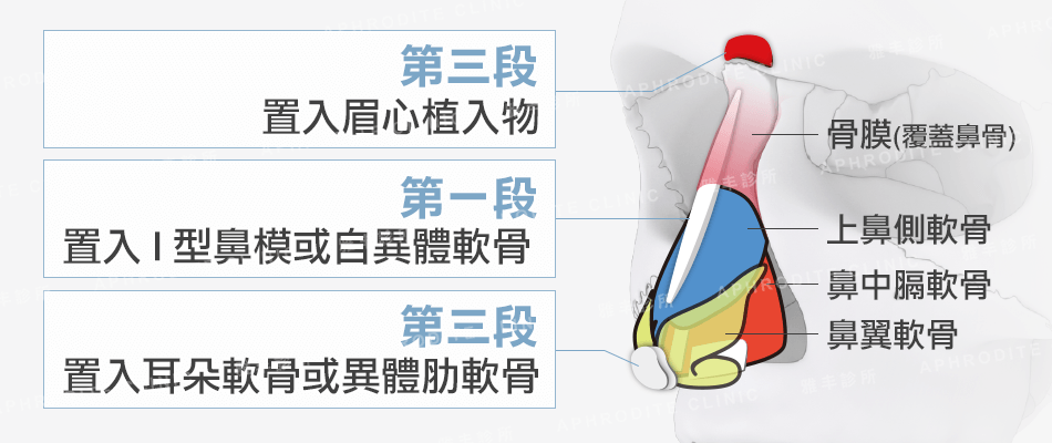 結構式隆鼻, 三段式隆鼻