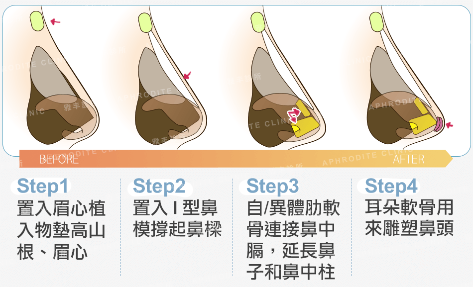 三段式隆鼻圖解2