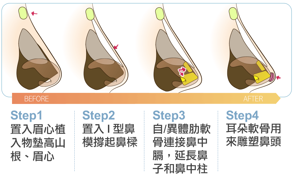 三段式隆鼻圖解2